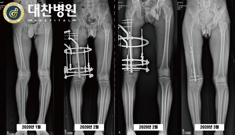 몽골환자까나수술경과15856137692220.jpg