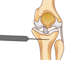무릎관절 교정술
