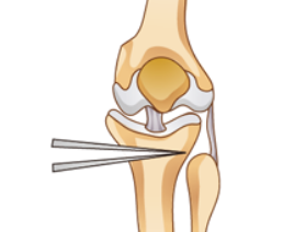 무릎관절 교정술