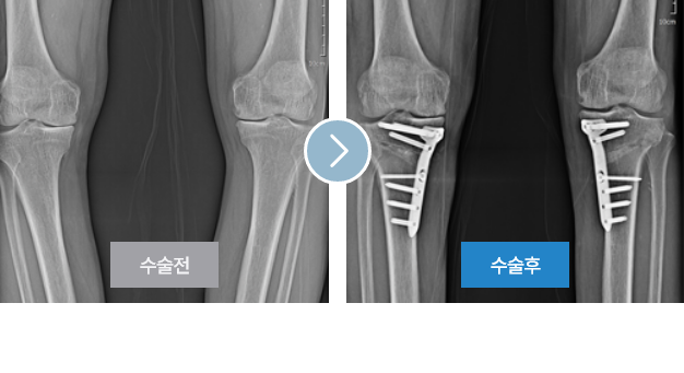 비수술적 보존치료